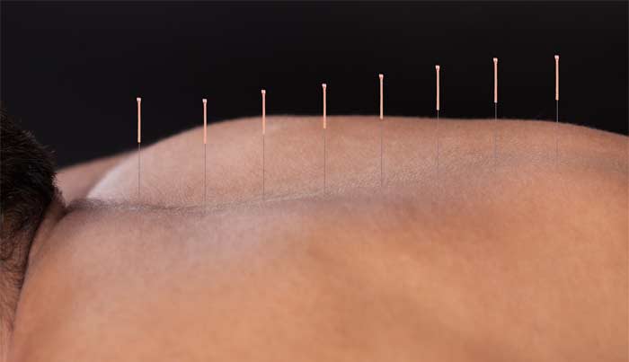 We offer Acupuncture Treatments