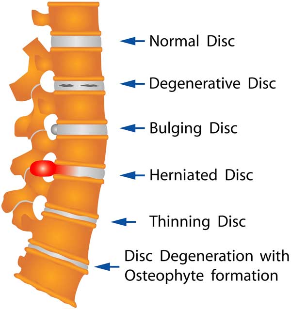 Common Disc Injuries