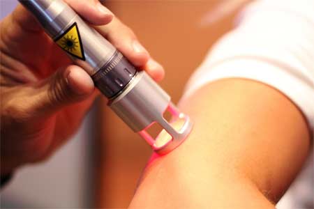 Laser Therapy on Elbow