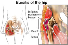 Bursitis hip area